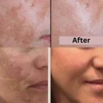 Shiv Aatman Anti Pigmentation Cream for Cure of Melasma, Hyperpigmentation, Dark  Spots, Sunburn, Tanned, Damaged Skin - Image 4