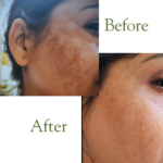 Pack of 2 (60 Days Course) - Shiv Aatman Anti Pigmentation Cream for Cure of Melasma, Hyperpigmentation, Dark  Spots, Sunburn, Tanned, Damaged Skin. 100% Results - Image 3