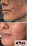 Pack of 2 (60 Days Course) - Shiv Aatman Anti Pigmentation Cream for Cure of Melasma, Hyperpigmentation, Dark  Spots, Sunburn, Tanned, Damaged Skin. 100% Results - Image 8