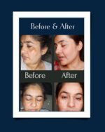 Shiv Aatman Dark Spots Removal Cream - Image 13