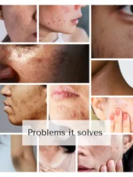 Shiv Aatman Anti Pigmentation Cream for Cure of Melasma, Hyperpigmentation, Dark  Spots, Sunburn, Tanned, Damaged Skin - Image 8