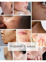 Pack of 2 (60 Days Course) - Shiv Aatman Anti Pigmentation Cream for Cure of Melasma, Hyperpigmentation, Dark  Spots, Sunburn, Tanned, Damaged Skin. 100% Results - Image 14