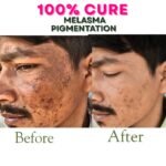 Pack of 2 (60 Days Course) - Shiv Aatman Anti Pigmentation Cream for Cure of Melasma, Hyperpigmentation, Dark  Spots, Sunburn, Tanned, Damaged Skin. 100% Results - Image 5