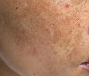 Pack of 2 (60 Days Course) - Shiv Aatman Anti Pigmentation Cream for Cure of Melasma, Hyperpigmentation, Dark  Spots, Sunburn, Tanned, Damaged Skin. 100% Results photo review