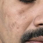 Pack of 2 (60 Days Course) - Shiv Aatman Anti Pigmentation Cream for Cure of Melasma, Hyperpigmentation, Dark  Spots, Sunburn, Tanned, Damaged Skin. 100% Results photo review