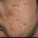 Pack of 2 (60 Days Course) - Shiv Aatman Anti Pigmentation Cream for Cure of Melasma, Hyperpigmentation, Dark  Spots, Sunburn, Tanned, Damaged Skin. 100% Results photo review