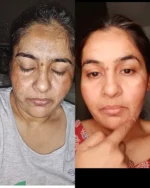 Pack of 2 (60 Days Course) - Shiv Aatman Anti Pigmentation Cream for Cure of Melasma, Hyperpigmentation, Dark  Spots, Sunburn, Tanned, Damaged Skin. 100% Results - Image 4
